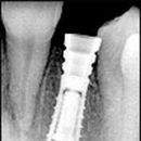 Poextrační implantát B85