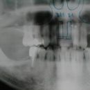Poextrační implantáty v HČ