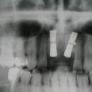 Zavedené poextrakční implantáty AUTOFIX B85