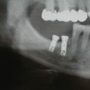 Implantáty B23 a B22