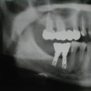 Implantáty B22 a B23 s protetikou