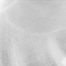 Sinus lift