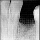 Poextrační implantáty a sinus lift