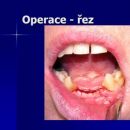 Operace - řez