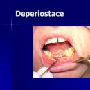 Deperiostace