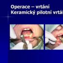Operace - vrtání
