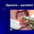 Operace - paralelní vrtání