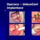 Dokončení implantace
