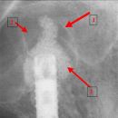 Sinus lift II