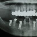 Implantáty před zhotovením otisku