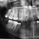 Distrakce + Nanoimplant