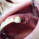Nanoimplant - ukázky prací I.