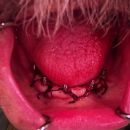 Po implantaci (METODA FLAP)