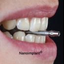 NANOIMPLANT