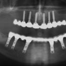 Totální protéza - DČ je 5 let po zatížení, HČ je rok zatížena nanoimplantáty (6/2009)