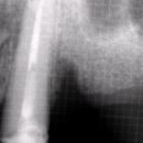 NANOIMPLANT D a SINUS LIFT