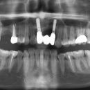 NANOIMPLANT a OTEVŘENÝ SINUS LIFT