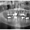 IMPLANTÁTY PO 14 LETECH